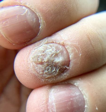 How Does RevaNail Works?